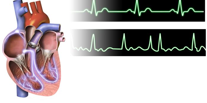 Four RNA Molecules that Predict an Irregular Heartbeat