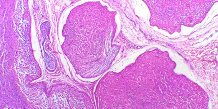 DNA Safeguard May Be Key in Cancer Treatment