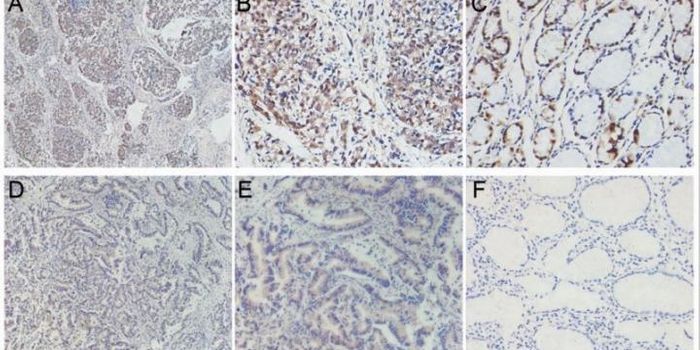 Biomarkers Affected By Alcohol Linked to Survival of Gastric Cancer Patients
