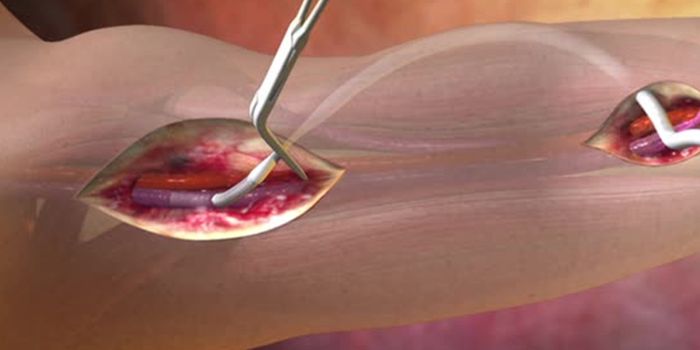 The Detrimental Side Effects of Vascular Grafts