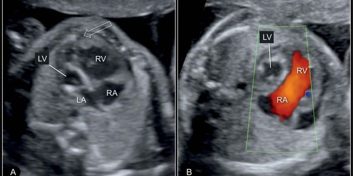 First-Ever Genes Discovered to Cause Rare Congenital Heart Defect