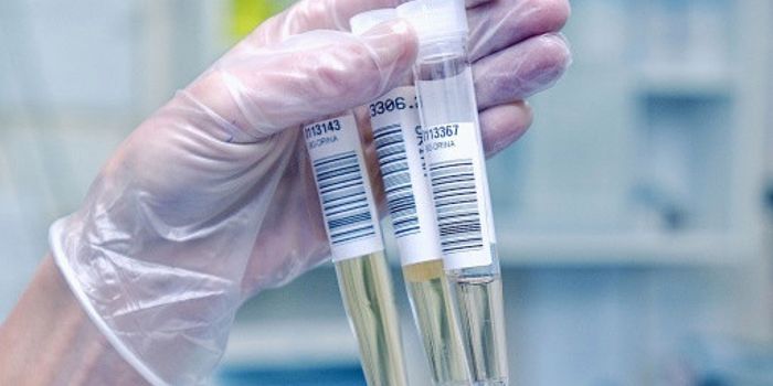 Urine Test Shows Promise in Detection of Cervical Cancer