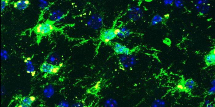 Gene Variants That Raise Alzheimer's Risk Cause Brain Inflammation