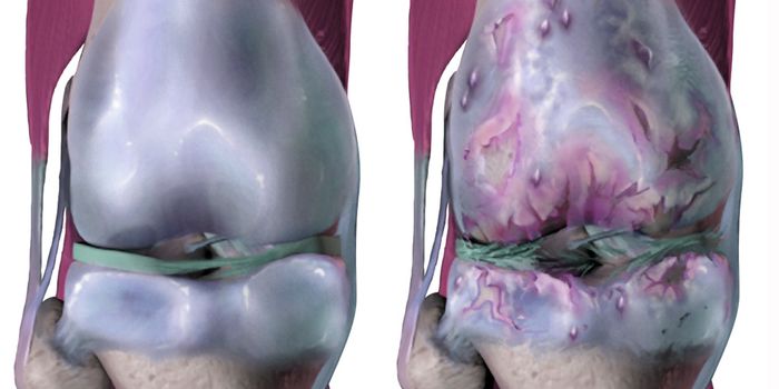 New Nanopore Sensor Detects Molecule in Osteoarthritis