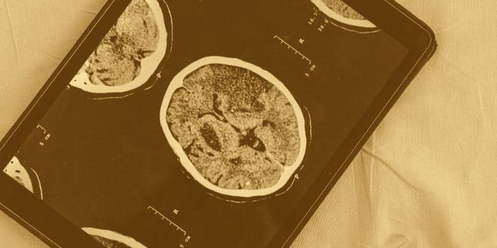 Prompt TBI Treatment Reduces Alzheimer's Risk by up to 41%