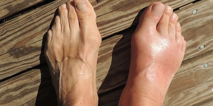 Gout Risk Linked to Small Genetic Change