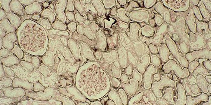 A Molecule Could Stop Lung Cancer Metastasis to the Brain
