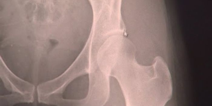 Hip Dysplasia: A Precursor To Arthritis With Variable Severity