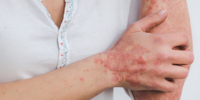 Newest treatment for psoriasis, a disease that affects 3% of the American population
