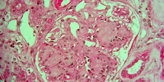 Personalized Anti-Inflammatory Treatment for Type 1 Diabetes