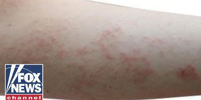 Can Scabies Be Deadly?