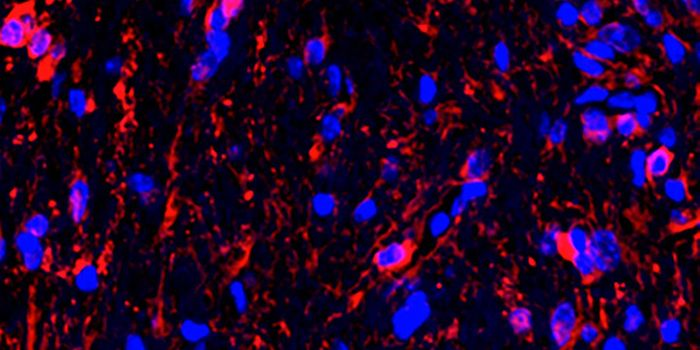 Tumor Growth in NF1 Kids May Begin When Optic Nerve Fires
