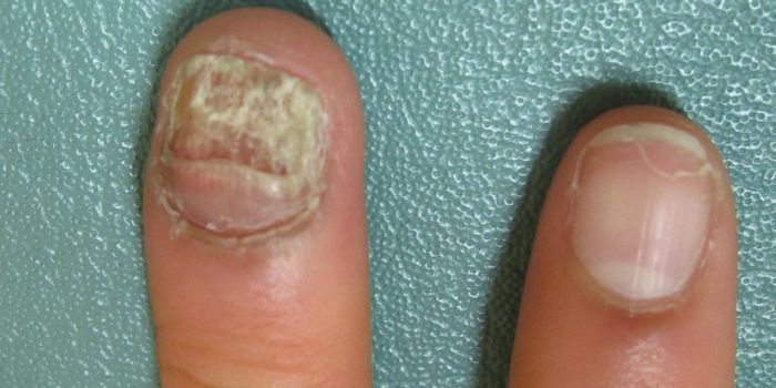 Stem Cell Treatment is Both Disappointing and Promising