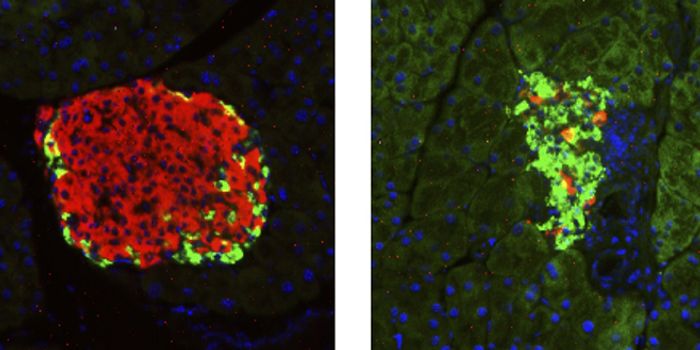 Diabetes: The next-generation therapy