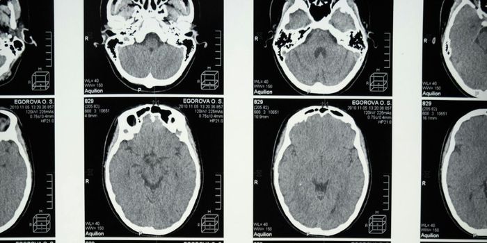 Side Effects of New Alzheimer's Drug are 'Manageable'