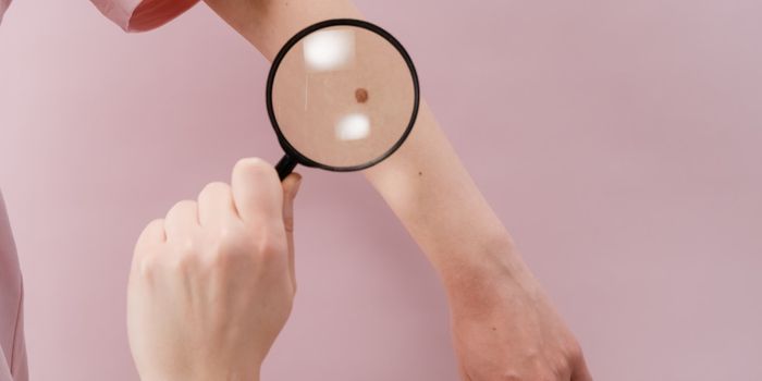 The Age of mRNA Cancer Vaccines Starts with Melanoma