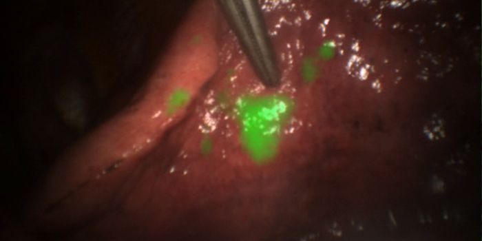 Brain Tumors All Aglow