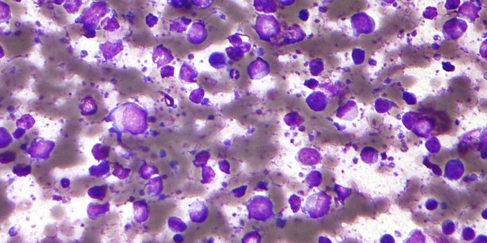 Researchers Identify Genetic Links to Lymphoma
