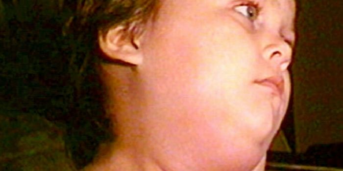 Mumps Outbreaks Are on the Rise