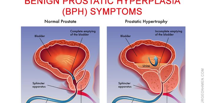 New Treatment Option for the Non-Cancerous Form of the Prostate
