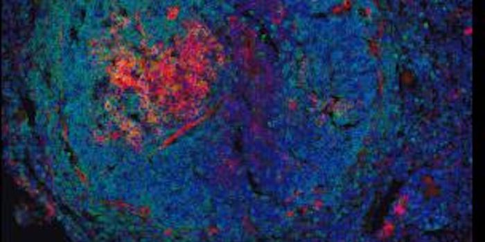 An Autoimmune Link to Heart Disease is ID'ed