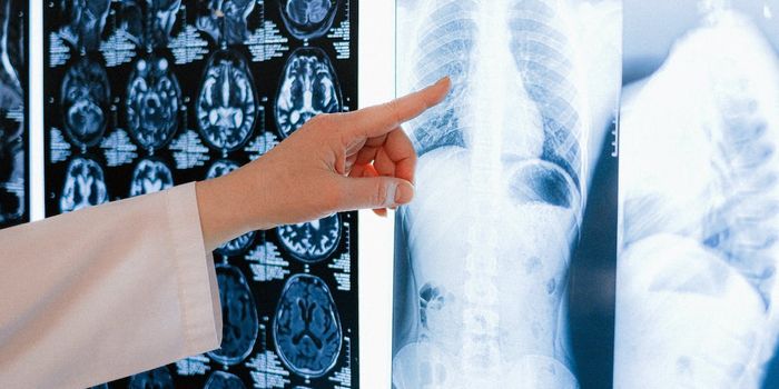 A Urine Test That Detects Cancer