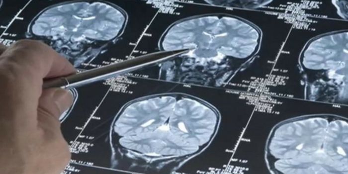 Can Brain Imaging Predict Autism Risk?