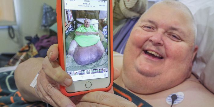 Misdiagnosed: 'Fat' Man Actually Plagued With 130-Pound Tumor