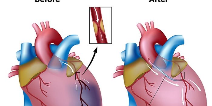 Heart Bypass Surgery Outperforms New Generation Stents