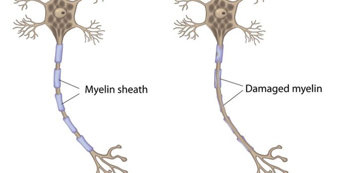 Multiple sclerosis treatments hold long-term benefits