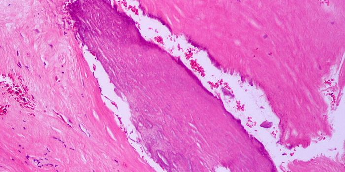 When Low-Risk People Still Get Atherosclerosis