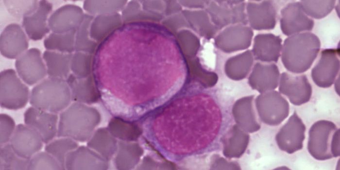 Reducing the Side Effects of Leukemia Treatments