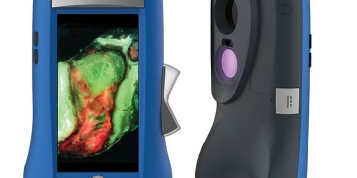 Handheld Scanner Shows Wound Bacteria in Real Time