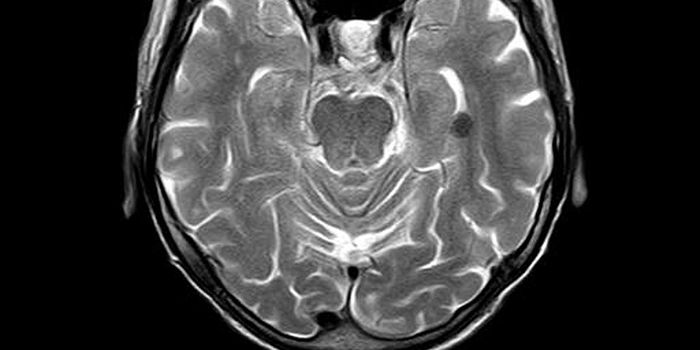 Nighttime Blood Pressure Changes Linked to Cerebrovascular Disease and Impaired Cognition