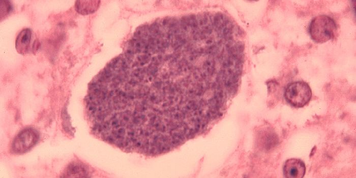 Genetic Mutation Provides Protection from Malaria