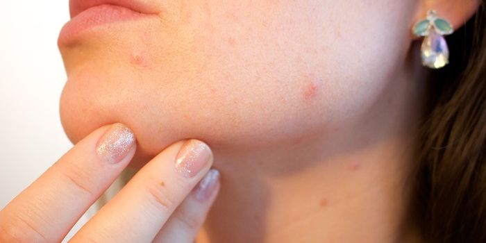How Different Strains of Bacteria Impact Acne