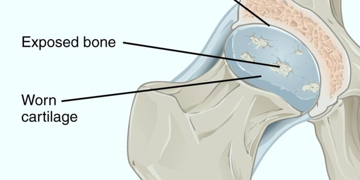 Vaccine Blocks Osteoarthritis Pain in Mice