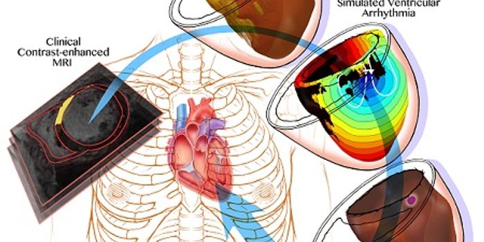 3D Virtual Stimulation Detects Irregular Heartbeats