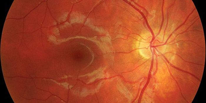 Stopping Inflammation Early to Prevent Blindness From Macular Degeneration