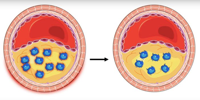 Newly-IDed Atherosclerosis Protein May Be Treatment Target