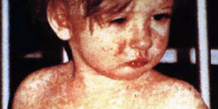What's Behind the Massive Measles Outbreak in Europe?