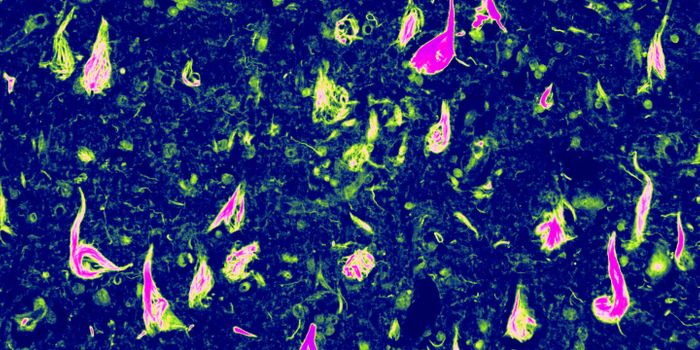 A Rare Form of Dementia is Discovered