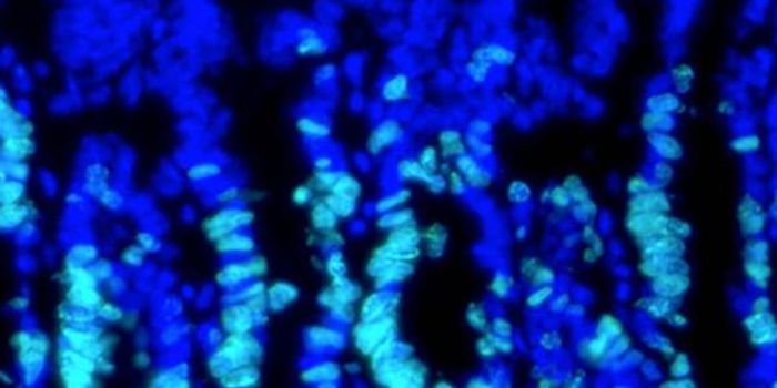 The Mechanism Linking Colon Cancer and High Cholesterol