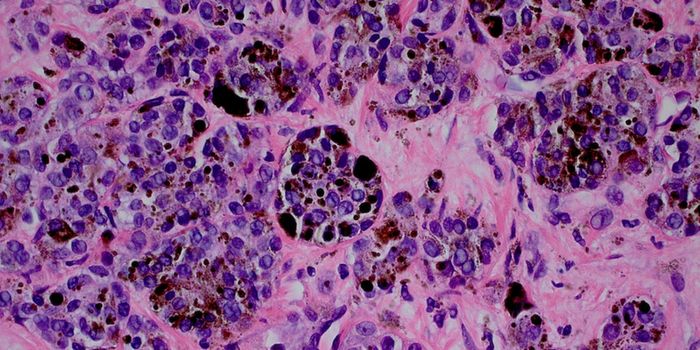 Potential New Treatment to Block the Mechanism for Cancer Metastasis