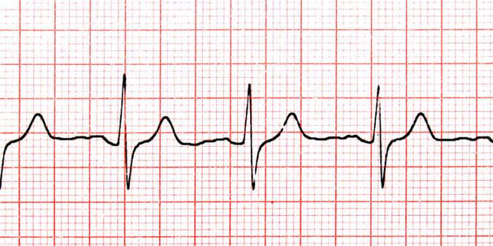 Heart arrhythmia linked to smaller brains