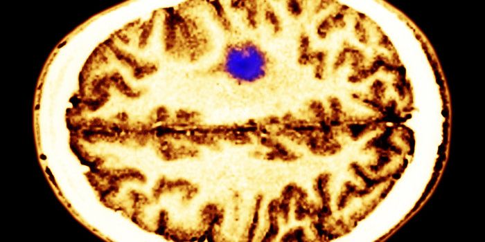 Thoughts Can Fuel Some Deadly Brain Cancers