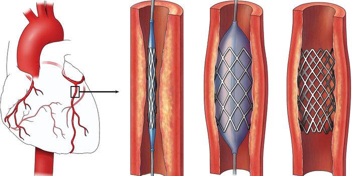 Building New Routes for Surgical Stents and Artery Repair