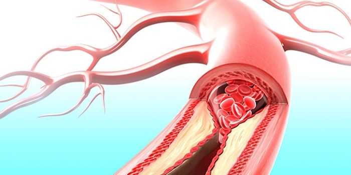 Routine Clot Removal After Heart Attack May Increase Stroke Risk