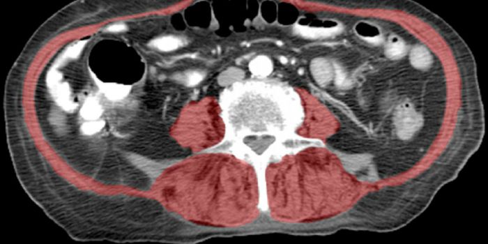Beyond Broken Hips, CT Scans Predict Survival