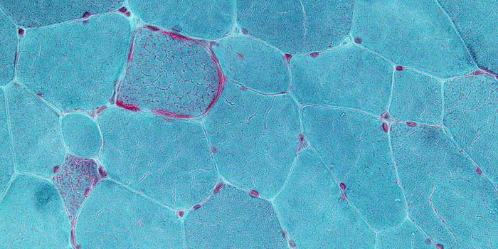 The Link Between Mitochondrial Diseases and its Neurological Symptoms